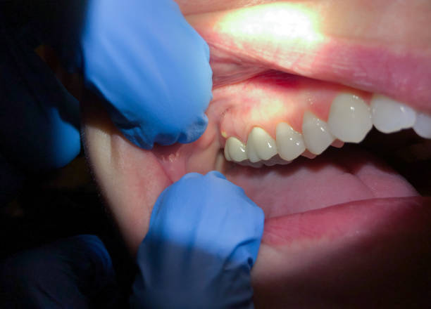 Best Emergency Dental Care for Broken or Chipped Teeth in Difficult Run, VA
